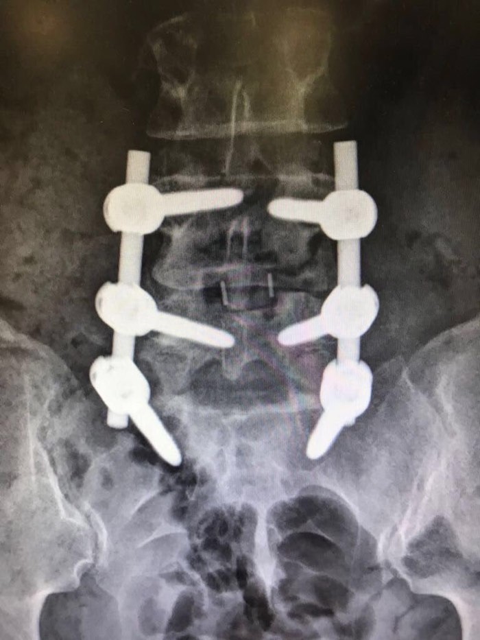 Radiografía frontal de la columna de Karla con la fijación de tornillos