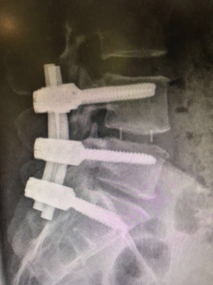 Radiografía lateral de la columna de Karla con la fijación de tornillos